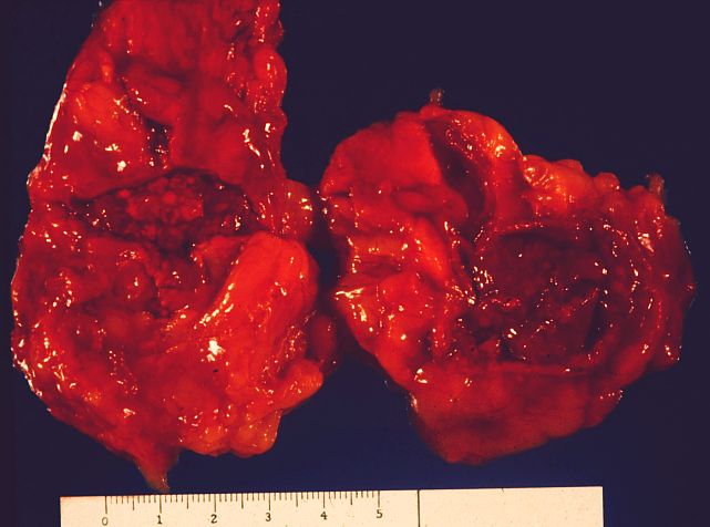 Zespół Waterhouse’a-Friderichsena