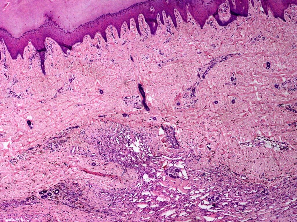 Angiomatosis bacillaris