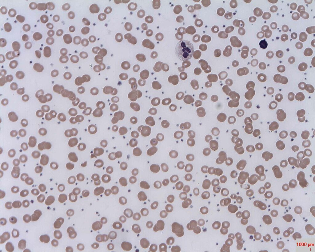 Nadpłytkowość samoistna