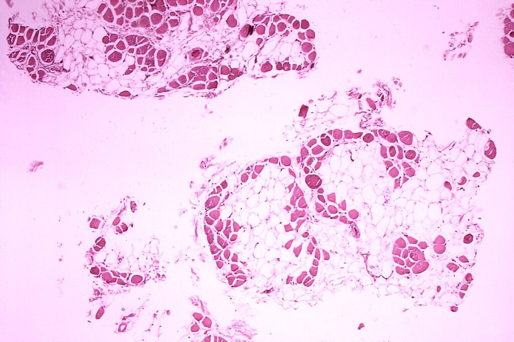 Dystrofia mięśniowa Duchenne’a