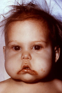 Kwashiorkor