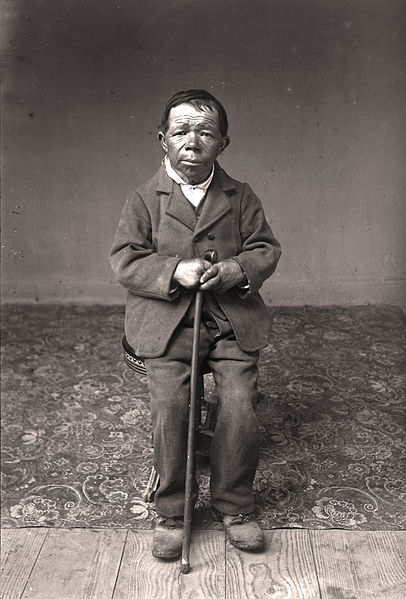 Wrodzony zespół niedoboru jodu