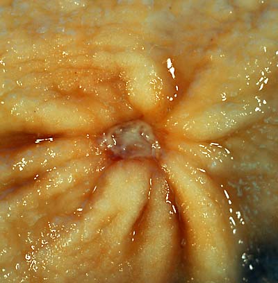 Choroba wrzodowa