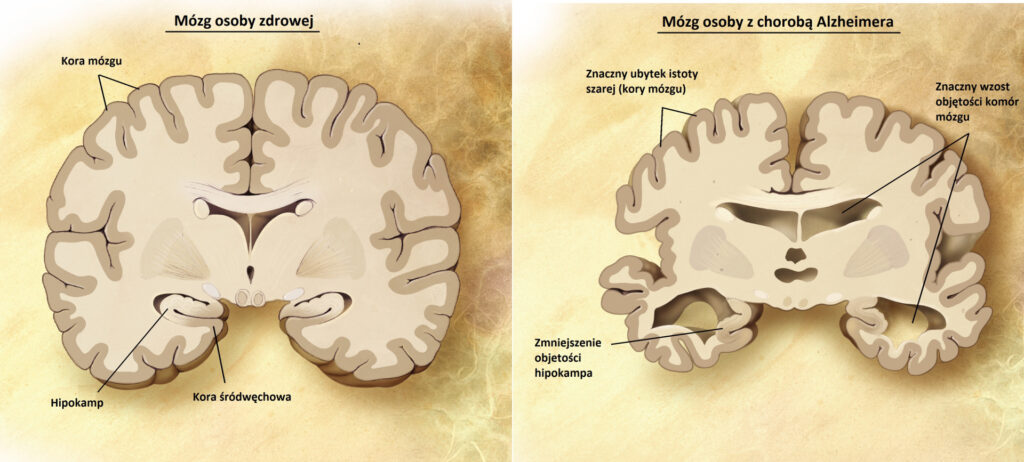 Choroba Alzheimera