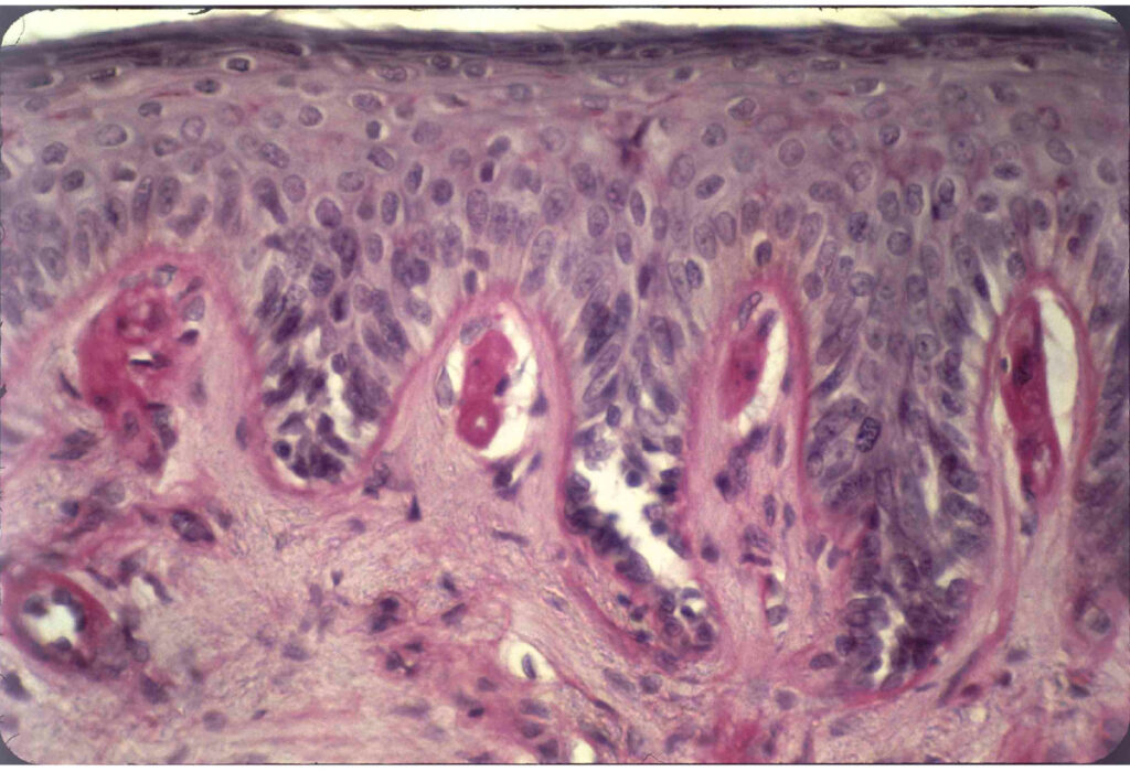 Protoporfiria erytropoetyczna