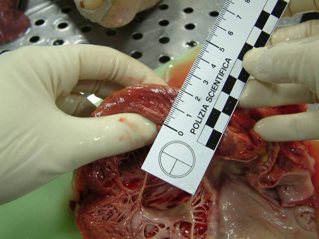 Kardiomiopatia przerostowa