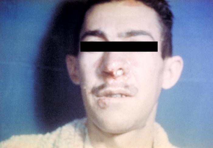 Parakokcydioidomikoza