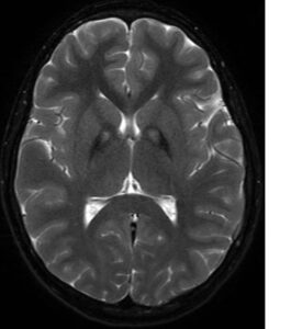 Neurodegeneracja związana z kinazą pantotenianu