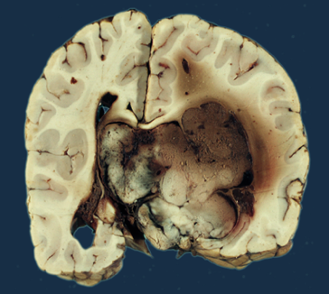 Brodawczak splotu naczyniówkowego